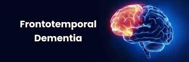 A 3D rendered brain with the Fronto and Temporal Lobes highlighted with the caption Frontotemporal Dementia